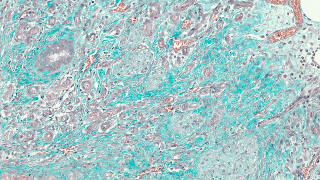 Mô đệm xơ hóa, nhuộm Trichrome